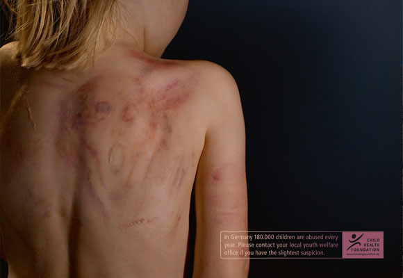 Child Abuse